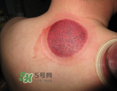 三伏天拔罐后多久可以洗澡？三伏天拔罐后注意事項(xiàng)