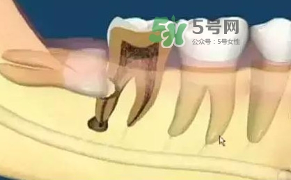 智齒是每個(gè)人都會(huì)長(zhǎng)嗎？拔智齒能瘦臉嗎？