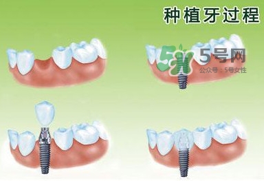 種植牙費(fèi)用多少錢？國(guó)產(chǎn)種植牙價(jià)格