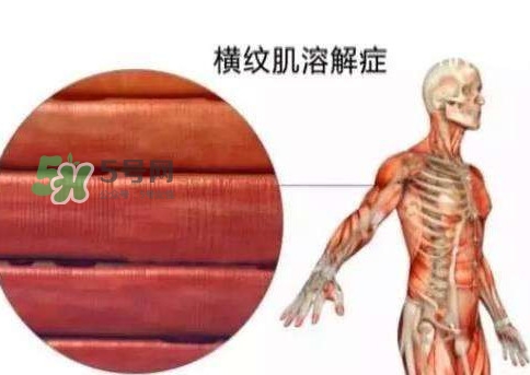 橫紋肌溶解癥會(huì)死亡嗎？橫紋肌溶解癥能活多久