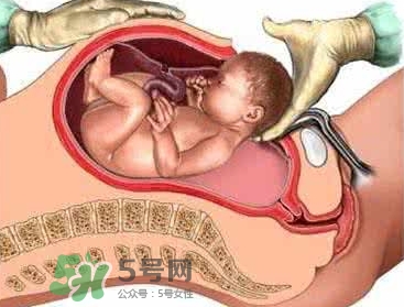 剖腹產(chǎn)比順產(chǎn)安全嗎？剖腹產(chǎn)產(chǎn)后注意事項？
