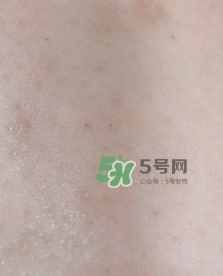 Dermatix舒痕疤痕膏有效嗎？Dermatix舒痕疤痕膏怎么用？