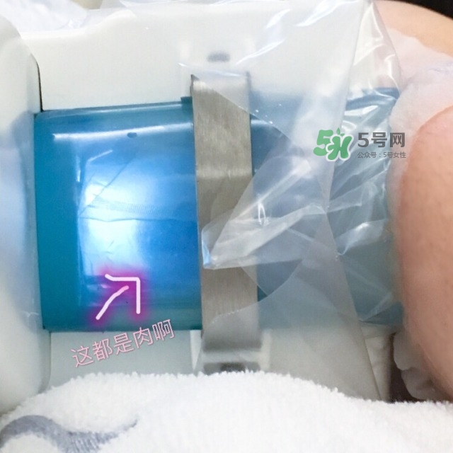 酷塑溶脂效果對(duì)比圖片 酷塑溶脂全過程記錄