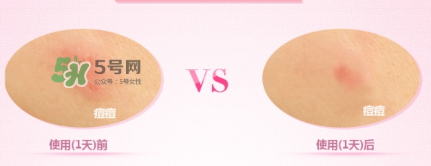 3m痘痘貼怎么用？3m痘痘貼貼多久？