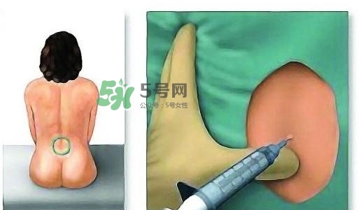 無(wú)痛分娩為什么不提倡？無(wú)痛分娩有后遺癥嗎？