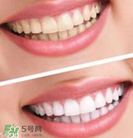 碧緹福美牙儀對牙齒有傷害嗎？碧緹福美牙儀會(huì)反彈嗎？