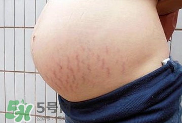 妊娠紋什么時候開始預(yù)防？妊娠紋什么時候消除？