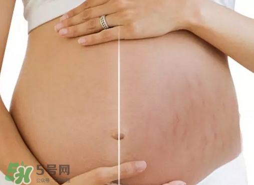 脖子上會長妊娠紋嗎？妊娠紋長在哪些地方？