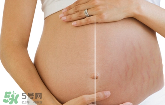 妊娠紋在左邊生男或女？怎么從妊娠紋看男女？