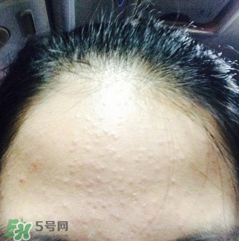 長痘長閉口怎么辦？長痘長閉口是什么原因？