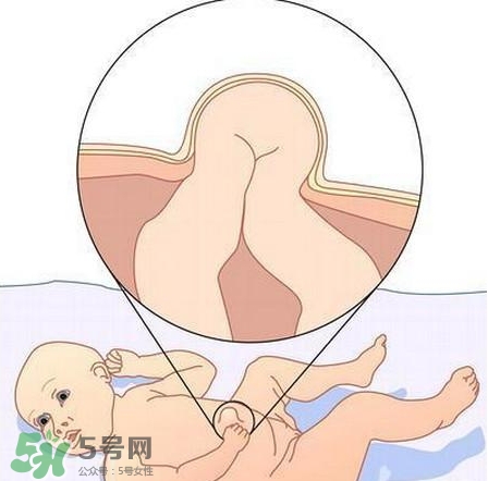 臍疝是什么？臍疝對寶寶有什么影響？