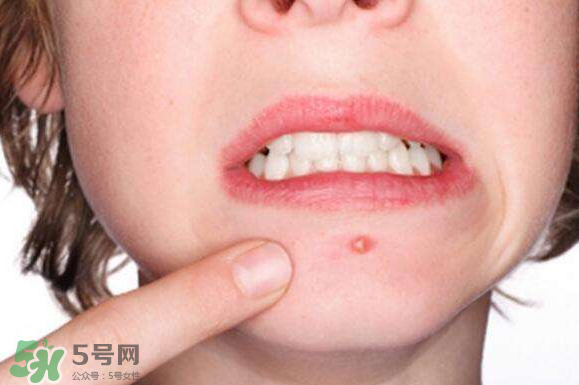 暗瘡可以擠壓嗎？油性和骯臟肌膚會容易有暗瘡嗎？
