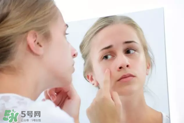 暗瘡可以擠壓嗎？油性和骯臟肌膚會容易有暗瘡嗎？