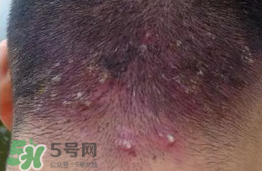 痤瘡和毛囊炎一樣嗎？痤瘡與毛囊炎區(qū)別