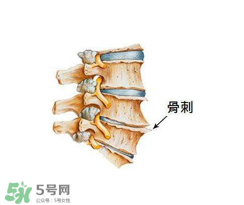 骨刺是怎么形成的？骨刺怎么治療？