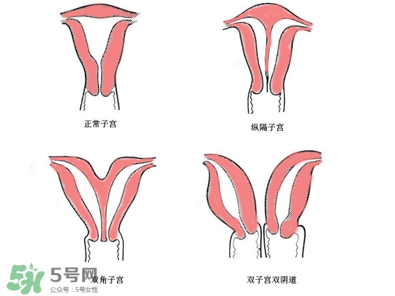 雙子宮是什么意思？雙子宮可以順產嗎？