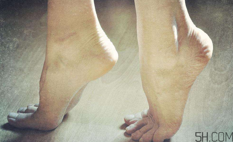 腳氣是什么原因引起的？腳氣是濕氣重引起的嗎?
