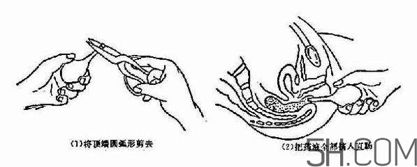 開塞露怎么用？開塞露用后多久會排便？