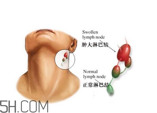 淋巴癌能活多久？淋巴癌癥狀有哪些