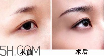 切眉手術(shù)后老得快嗎？切眉能保持多久？