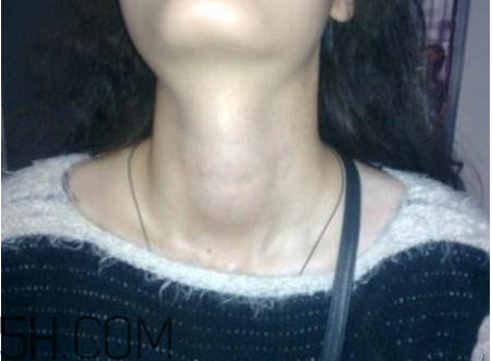 甲狀腺結(jié)節(jié)掛什么科？甲狀腺結(jié)節(jié)可以懷孕嗎