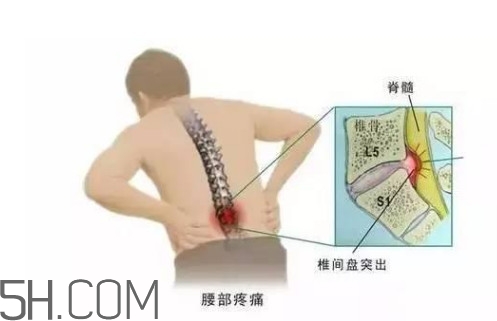 腰間盤(pán)突出是什么原因引起的？腰間盤(pán)突出是腎虛嗎