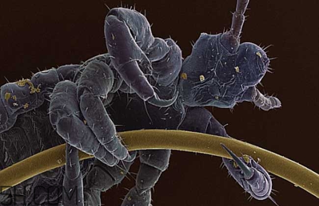 孩子長虱子是怎么回事？孩子長虱子該怎么辦？