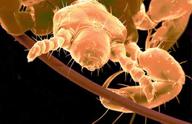 孩子長虱子是怎么回事？孩子長虱子該怎么辦？