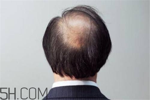 為什么男性比女性更容易脫發(fā)？什么原因?qū)е履行悦摪l(fā)？
