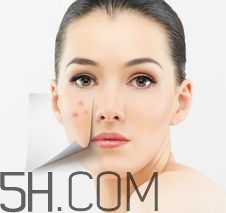 濕熱型痤瘡是什么？怎么調(diào)理濕熱型痤瘡？