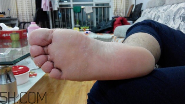 腳氣可以用酒精消毒嗎？腳氣可以用碘伏消毒嗎？
