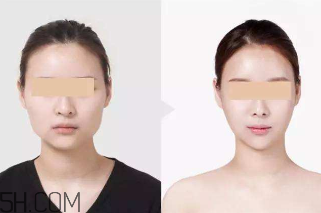 打瘦臉針可以抽煙嗎？打瘦臉針會反彈嗎？