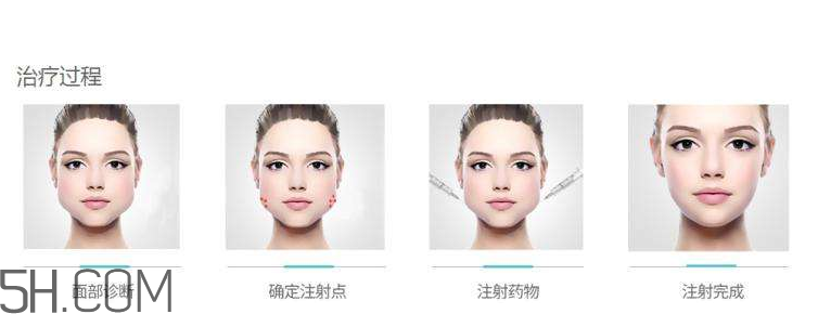 打瘦臉針可以抽煙嗎？打瘦臉針會反彈嗎？