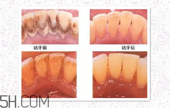 超聲波洗牙可以美白牙齒嗎？超聲波洗牙多少錢(qián)一次？