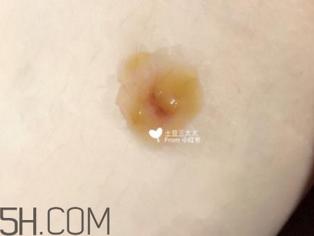 美寶濕潤(rùn)燒傷膏怎么樣？美寶濕潤(rùn)燒傷膏有用嗎？