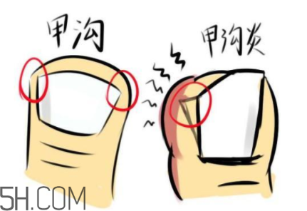 為什么容易得甲溝炎？怎么根治甲溝炎？