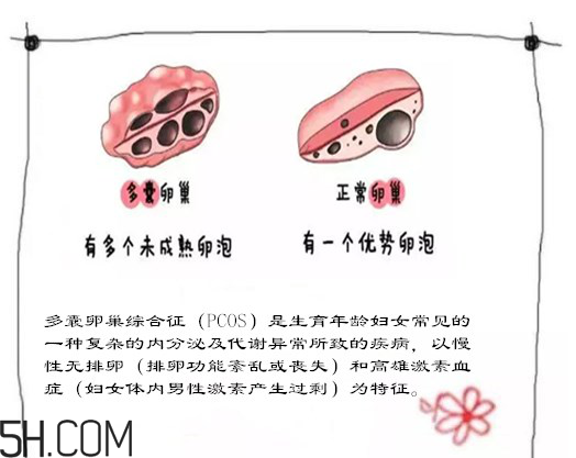 多囊卵巢生不了？多囊卵巢懷孕要看準(zhǔn)時間