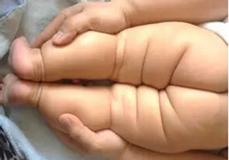 寶寶腿紋不對稱是怎么回事？嬰幼兒的生長發(fā)育標準是怎樣的？