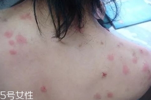 螨蟲有哪些危害？嚴(yán)重時(shí)肌膚糜爛