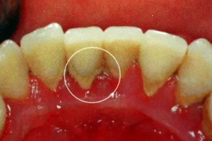 牙結(jié)石能自動(dòng)脫落嗎？除了洗牙別無(wú)他法