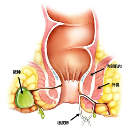肛瘺非手術(shù)治療才可以嗎？手術(shù)是治療的關(guān)鍵途徑