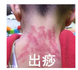 吮痧有什么療效？最溫柔的治病方法