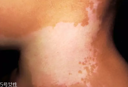 痣什么情況下會轉變?yōu)榱?？點痣不可取