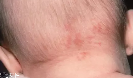 痣什么情況下會轉變?yōu)榱?？點痣不可取