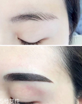 激光洗眉恢復期有疤痕怎么辦？激光洗眉毛之后正確護理方法