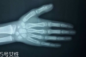 哪些人需要測骨齡？長太快警惕骨齡提前