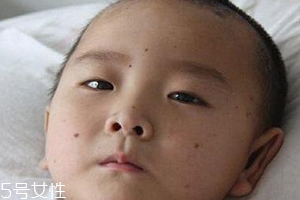 痣什么情況下會轉變?yōu)榱?？點痣不可取