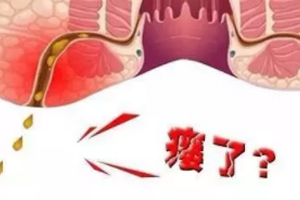 肛瘺非手術(shù)治療才可以嗎？手術(shù)是治療的關(guān)鍵途徑