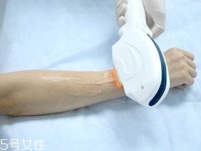 激光脫毛需要幾次？激光脫毛并不是終身有效的