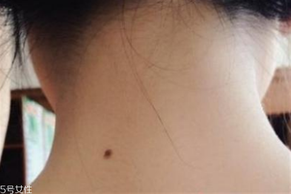 脖子后面有痣好嗎？激光冷凍祛痣易導(dǎo)致癌變